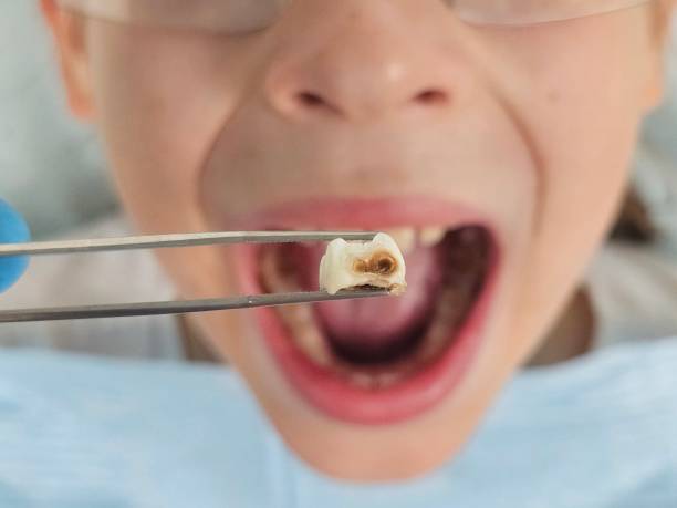 Best Emergency Tooth Extraction in Leesport, PA